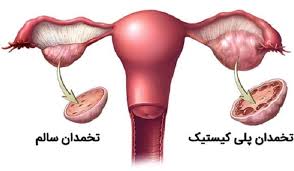 کیست تخمدان